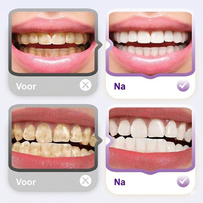 Lysozyme Verhelderende Vlekverwijderende Tandpasta